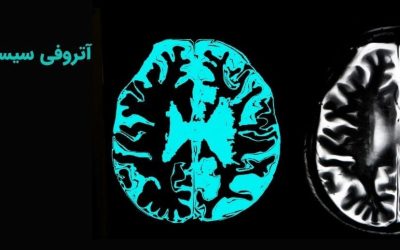 آتروفی سیستم چندگانه یا ام اس ای (MSA)
