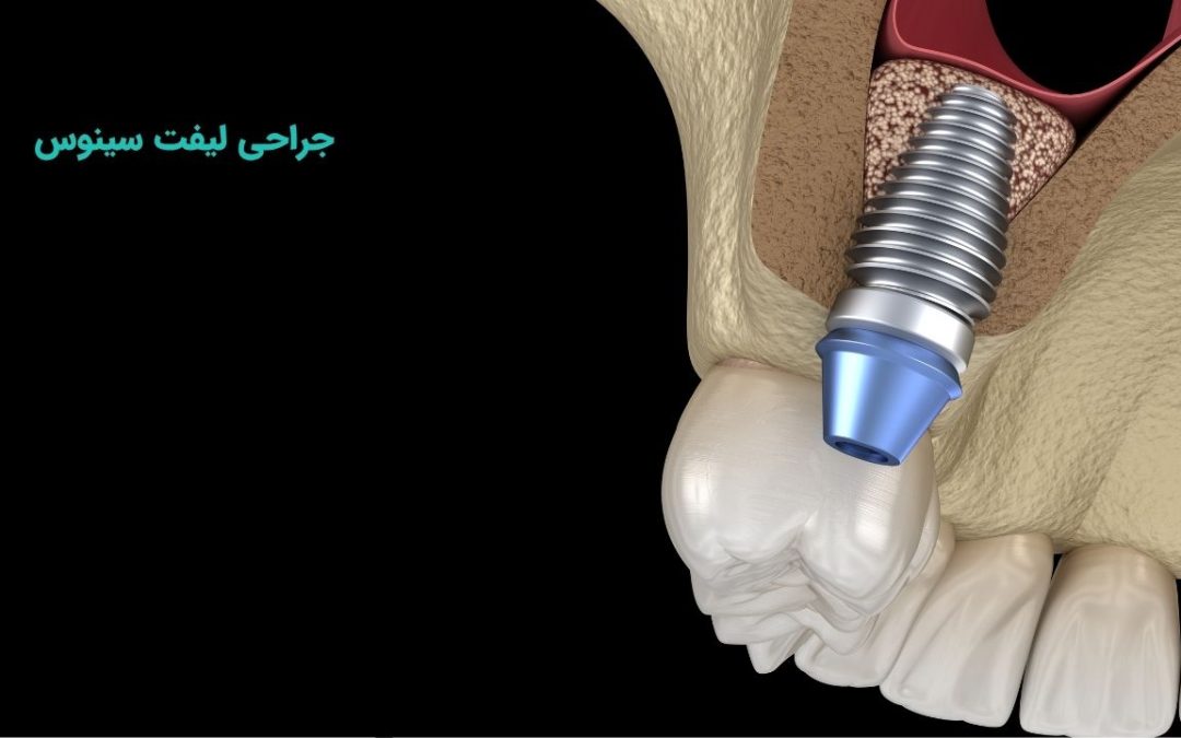 جراحی لیفت سینوس
