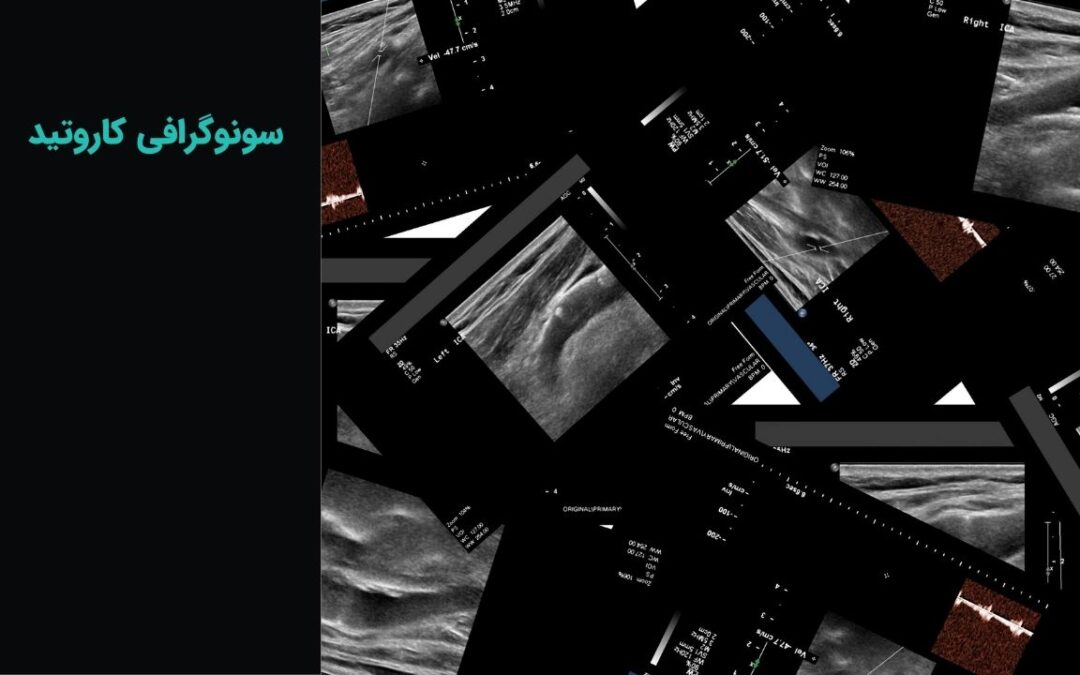 سونوگرافی کاروتید یا داپلر عروق گردن