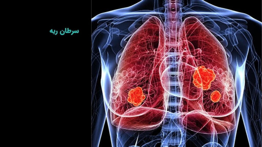 سرطان ریه