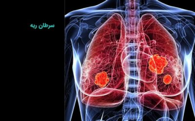 سرطان ریه چیست؟ تشخیص، درمان، علائم، علت و انواع
