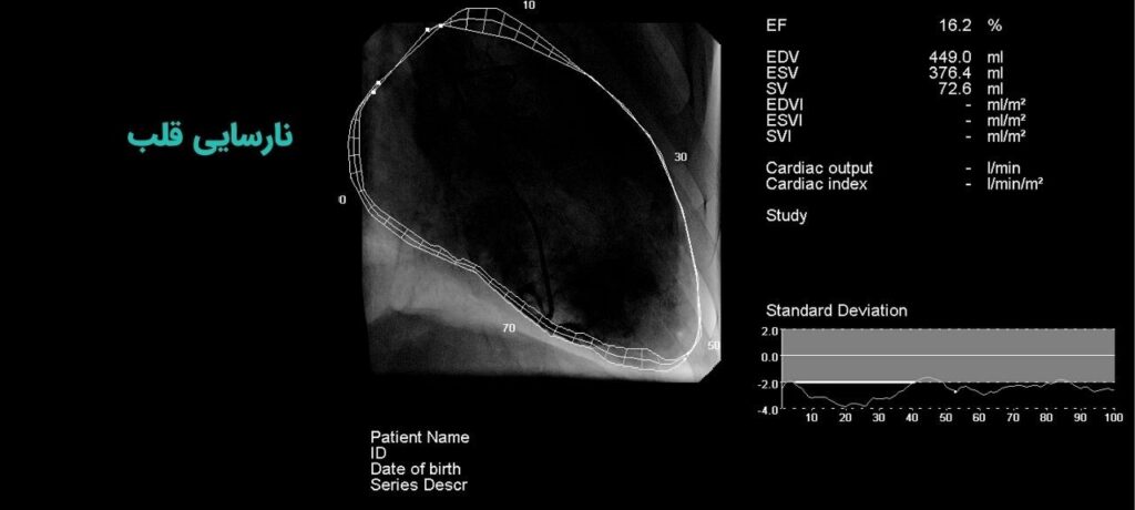 نارسایی قلبی