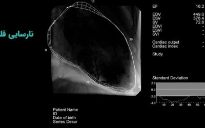 نارسایی قلبی چیست؟ علت، علائم، پیشگیری و درمان