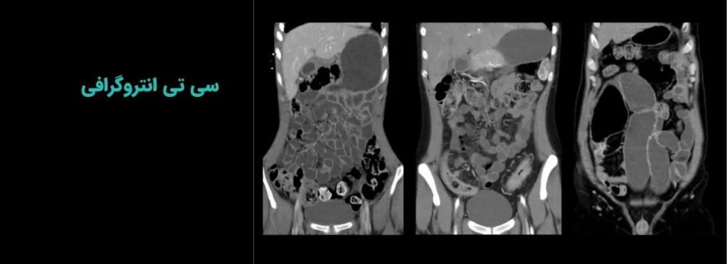 سی تی انتروگرافی