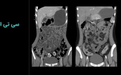 سی تی انتروگرافی: تمام نکاتی که نمیدانستید