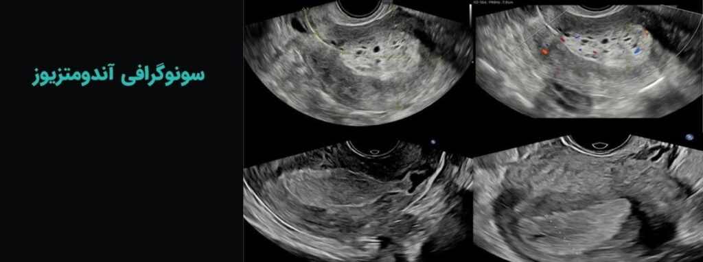 سونوگرافی اندومتریوز
