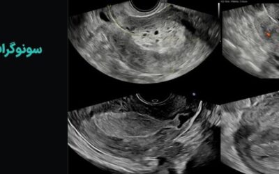 سونوگرافی اندومتریوز چیست؟ نحوه انجام و آمادگی قبل و بعد