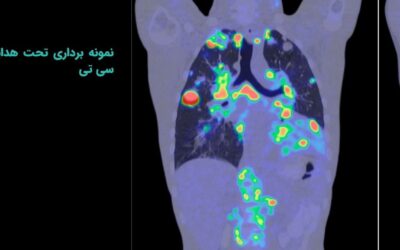نمونه برداری تحت هدایت سی تی اسکن
