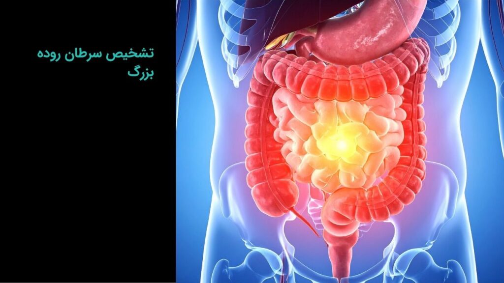 تشخیص سرطان روده بزرگ