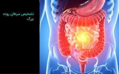 تشخیص سرطان روده بزرگ: بررسی جامع تمامی روشها