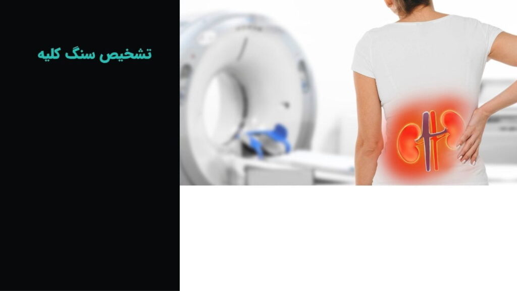 تشخیص سنگ کلیه