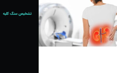 تشخیص سنگ کلیه: بررسی بهترین روشها