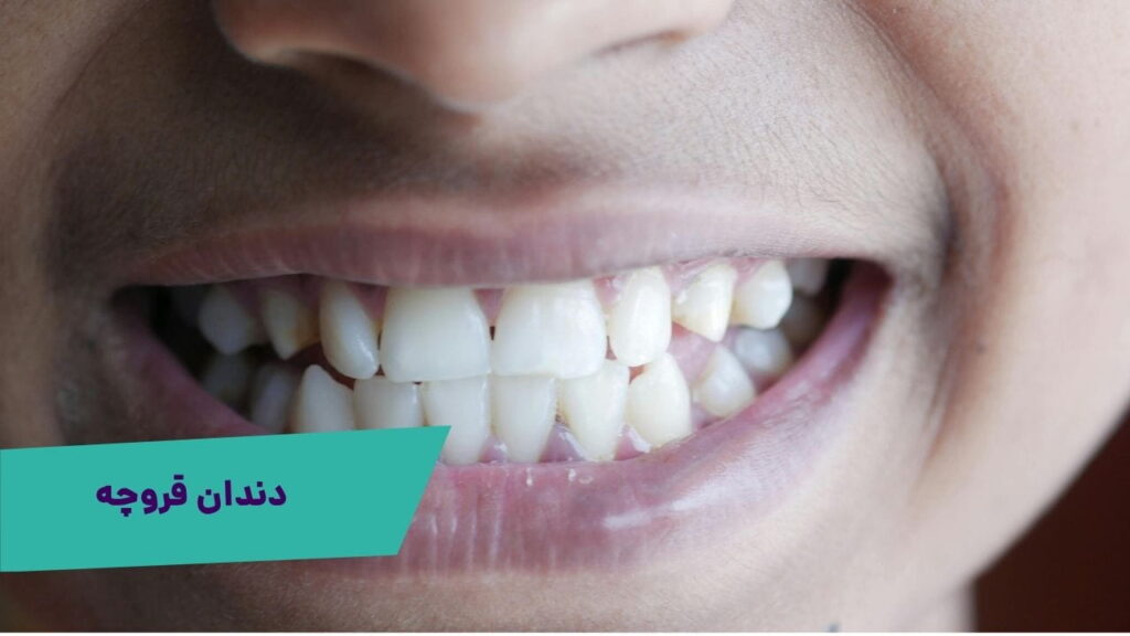 دندان قروچه