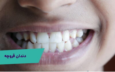 دندان قروچه چیست؟