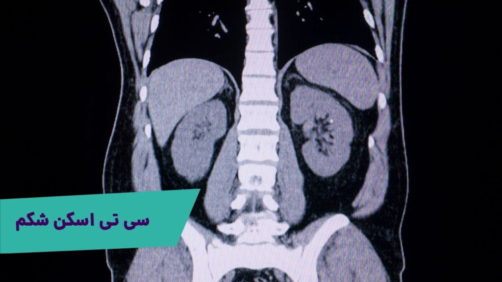 سی تی اسکن شکم